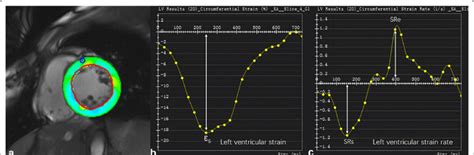 tracking lv|Lv tracking meaning.